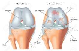 32764841-arthrosis-of-the-knee